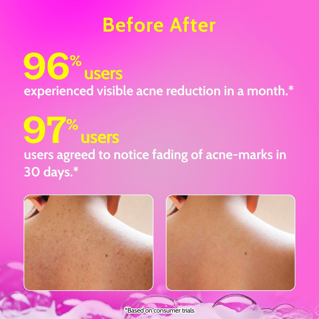 1% Salicylic Acid Body Wash for Acne Control - 236 ml | Pack of 2